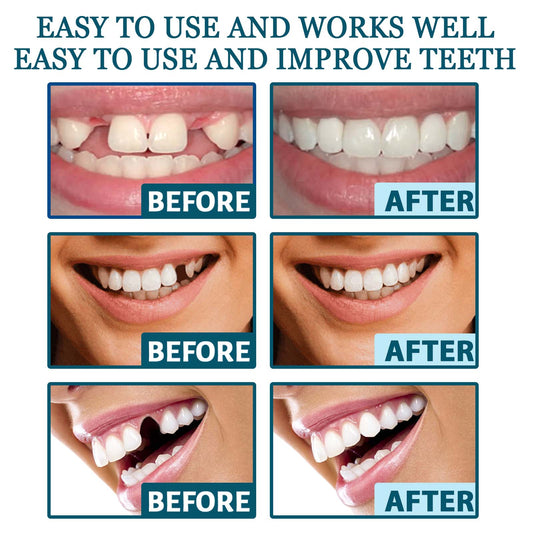 Adjustable Snap-On Dentures: Your Perfect Smile Solution - MANDOTOS